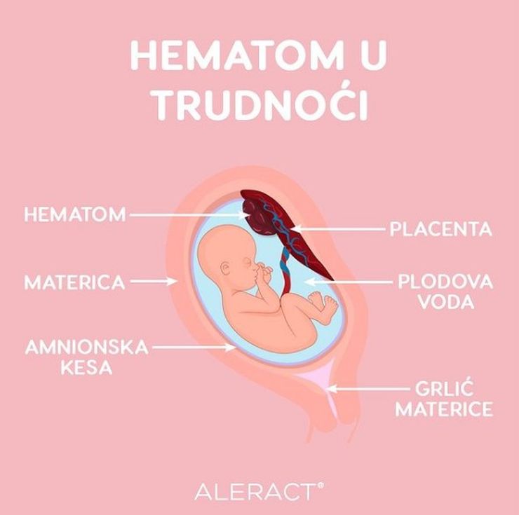 hematomi u trudnoći