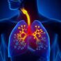 Kako da izlečite bronhitis