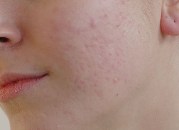 prikaz lica na kom su akne