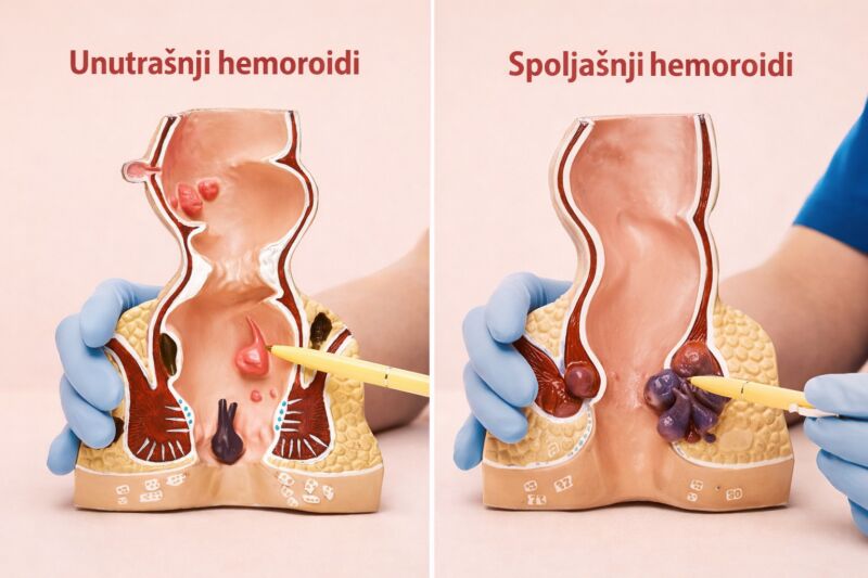Unutrašnji i spoljašnji hemoroidi