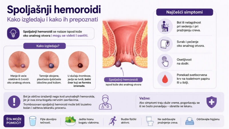 Infografik koji prikazuje kako izgledaju spoljašnji hemoroidi, njihove karakteristične promene na koži oko analnog otvora i najčešće simptome poput bola, svraba, pečenja i osetljivosti